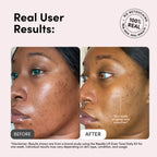 Needle Lift Cream Tone+ With 1,000,000 Micro-Spicules