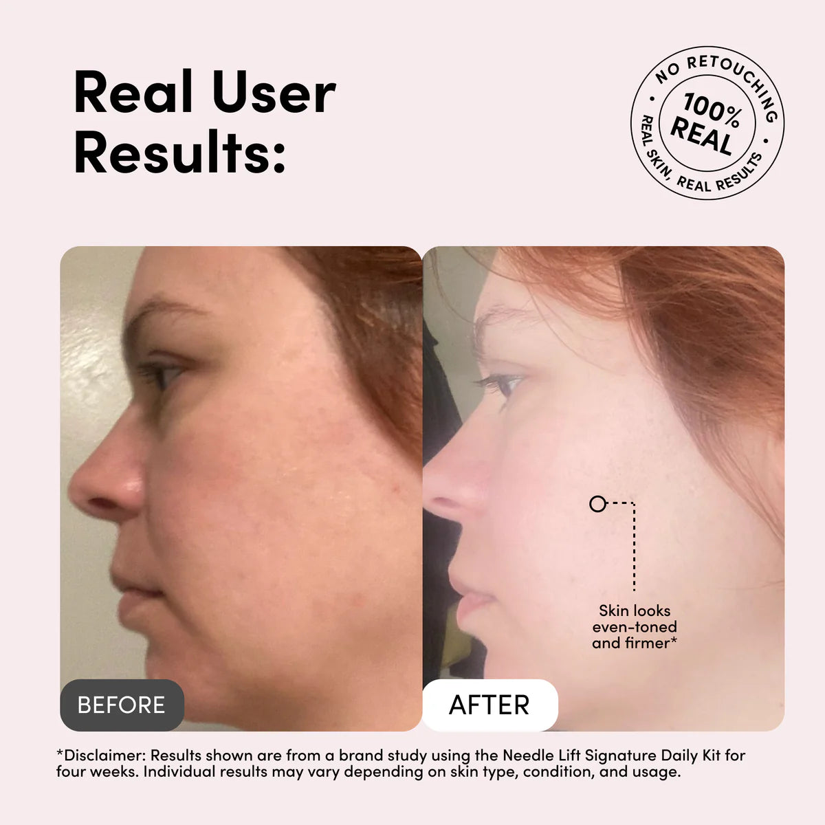 Needle Lift Signature Cream With 1 million Micro-Spicules